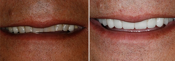 Full Mouth Rehabilitation Charlotte Full Mouth Rehabilitation Charlotte