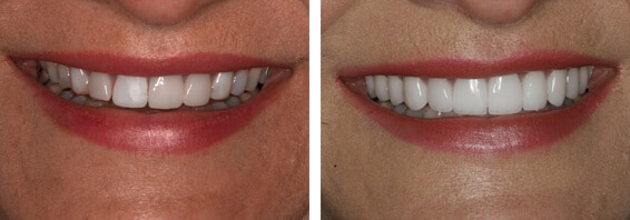 Mouth Rehab Before and After Charlotte Mouth Rehab Before and After Charlotte