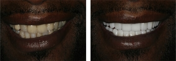 Mouth Rejuvenation Rehab North Carolina Mouth Rejuvenation Rehab North Carolina