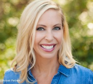 Image of a white woman with whitened teeth and beautiful smile, teeth whitening in Charlotte, NC.