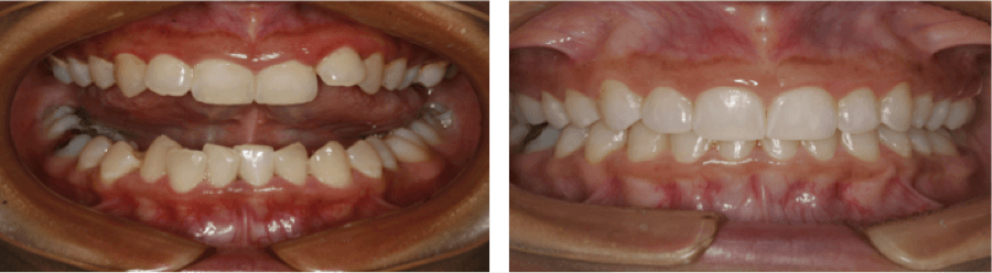 Invisalign Before and After | Charlotte Dentist | Destination Smile