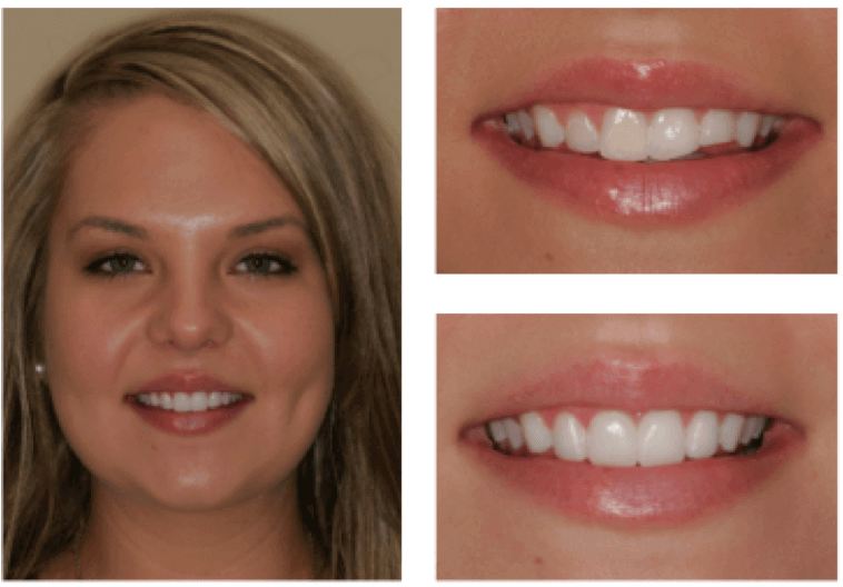 smile makeover before and after