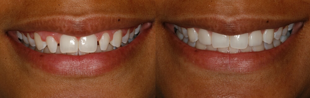 Incredible Smile Makeover With Gum Contouring & Veneers