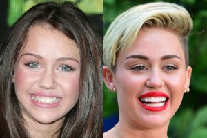 Image shows famous pop singer/songwriter with her smile transformation after having porcelain veneers