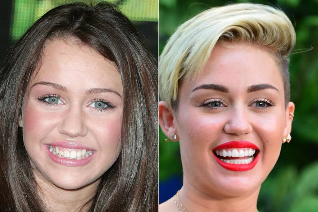 Celebrity Teeth Veneers