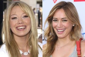 Image of Hillary Duff, a pop star with before smile with uneven teeth and chip and after smile photos using porcelain veneers