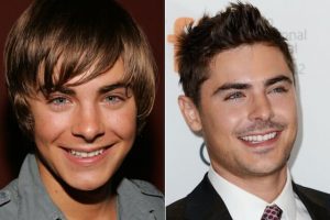 Images of famous TV star Zac Efron with his a gap in his front teeth in the before picture and no gaps after probable having porcelain veneers