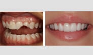 Before and After Veneer