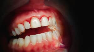 Image of teeth with bleeding gums, Charlotte, NC