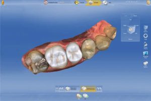 Cerec crown design software