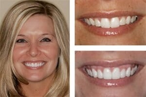 before after photo of a gummy smile procedure