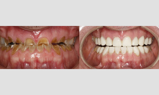 Full Mouth Rehabilitation Photos Destination Smile Full Mouth Rehabilitation Photos Destination Smile