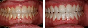 before after of teeth whitening procedure