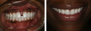 Invisalign results in Charlotte, NC