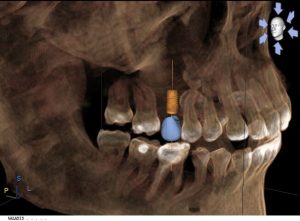 Single Visit Digital Dental Restoration in Charlotte, NC