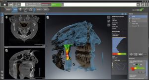 airway obstruction treatment in charlotte, nc