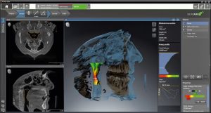 digital dentistry implants in charlotte, nc