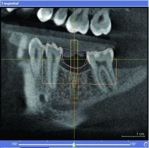 x-ray image of dental bridges in Charlotte